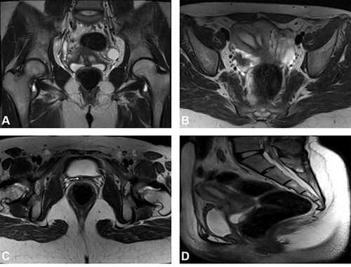 Figure 1 Case of complete septate uterus with urogenital sinus anomaly presenting with cyclic hematuria, categorized by AFS and ESHRE systems. (A) Coronal T2W image demonstrating duplicated cervices. (B and C) Axial T2W images showing complete septate uterus and the narrow connection (arrow) between the vagina and the urinary bladder. (D) Sagittal T2W image showing the dilated proximal vagina with non-visualization of its distal portion. A Gartner duct cyst is seen at its posterior wall.