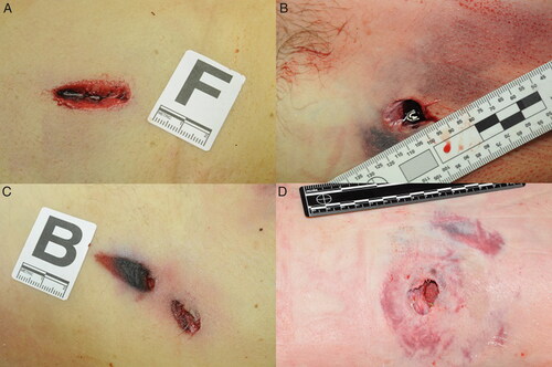 Figure 3. Photographs of representative ballistic entrance wounds. The projectile penetrated the skin laterally (A and C). The projectile penetrated the skin without deformation (B) and a deformed projectile penetrated the skin, causing an irregularly-shaped wound (D).