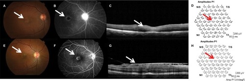 Figure 1 Evaluation of anatomical and functional status before and after treatment using FA, OCT, and ERG.Notes: (A) Ischemic retinopathy with alteration of foveal reflex (arrow) in the right eye. (B) Retinal FA showing ischemic retinopathy, especially involving the macular area (arrow). (C) OCT showed thickening and hyperreflectivity of the inner retinal layers (arrow). (D) Multifocal ERG showed a decrease in electrical responses from central macula (arrow). (E) Resolution of cotton wool spots (arrow). (F) Reperfusion of some previously ischemic areas during examination with fluorescein (arrow). (G) OCT showed formation of epiretinal membrane (arrow). (H) Multifocal ERG remained at low amplitudes corresponding to central area (arrow), indicating macular dysfunction.