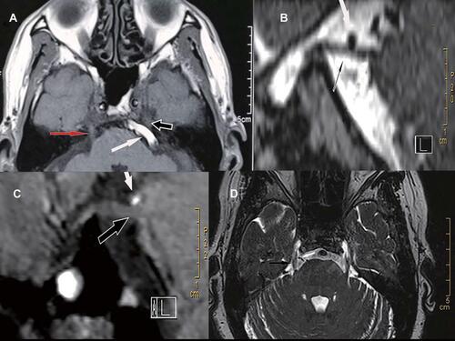 Figure 1 Preoperative magnetic resonance imaging (MRI) images under different neurovascular compression. (A) The left basilar artery (BA; white arrow) obviously compresses the trigeminal nerve (black arrow) and causes the nerve root to displacement. Note that the trigeminal nerve on the right (red arrow) has no vascular compression and no displacement. (B) The left superior cerebellar artery (SCA; white arrow) obviously compresses the trigeminal nerve (black arrow). (C) The SCA (white arrow) only contacts the trigeminal nerve (black arrow). Note that there is no cerebrospinal fluid visualized between the nerve and the artery. No deformity of the nerve is observed. (D) Only the vein (white arrow) compresses the right trigeminal nerve (black arrow).