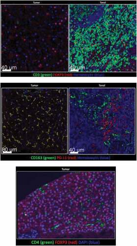 Figure 1. Tumor tissue and tonsil (control) stained for CD3, CD4, CD163, PD-L1. Few CD3+, or CD4+ cells were detected in tumor. FOXP3 was detected in tumor, but not with CD3+ or CD4+ cells. Majority of myeloid tumor cells expressed PD-L1