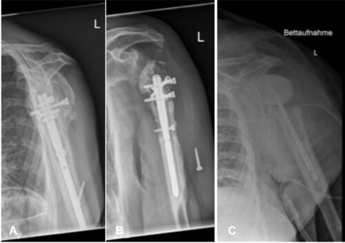 Figure 3 : (A) + (B) Removal of the loosened humeral nail; (C) Implantation of a cement spacer.