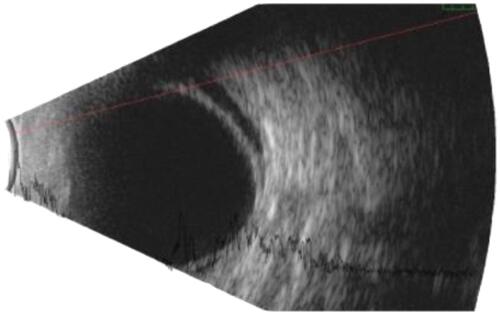 Figure 3 Retinal detachment shown in the ultrasound examination.