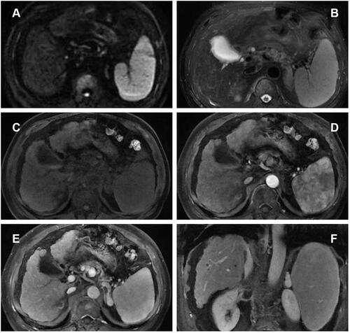 Figure 5 DCE‐MRI displayed the intrahepatic tumor and RV-IVCTT were complete responses after three cycles of treatments. ((A) DWI, (B) T2WI, (C) T1WI, (D) arterial phase, (E) portal phase, (F) coronal portal phase T1WI).