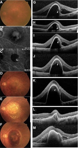 Figure 2 Images from case 3, an 80-year-old Japanese man with a large PED associated with a PCV in the left eye.