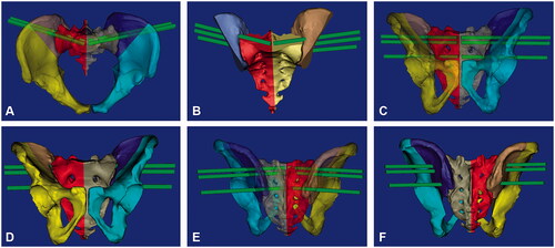 Figure 1. The design of screw entry points and channels of the sacroiliac joint. (A, B): upper view of three sacroiliac screw channels; (C, D): anterior view of three sacroiliac screw channels; (E, F): posterior view of three sacroiliac screw channels.