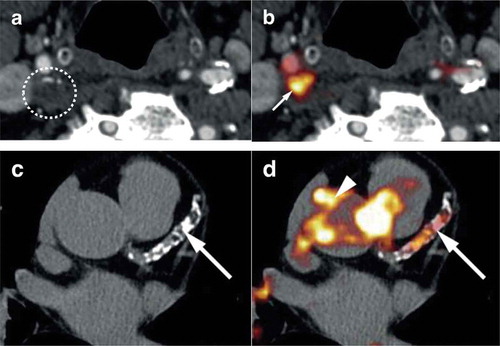 Figure 4. Representative images of vascular PET-CT imaging of disease activity in patients with atherosclerosis. Top: CT (a) and 18F-fluordeoxyglucose (FDG) PET-CT (b) images from a patient with recent transient ischemic attack resulting from a symptomatic right internal carotid artery stenosis (circle) demonstrating an intense focal inflammatory signal (arrow) on PET imaging. Bottom: CT (c) and 18F-sodium fluoride (NaF) PET-CT (d) images from a patient with stable angina showing high tracer uptake representing micro-calcification in relation to left anterior descending artery atherosclerosis (arrows), as well as the ascending aorta (arrowhead). Figure adapted from Tarkin et al [Citation124].