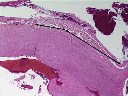 Figure 7 Hematoxylin and eosin staining of goat carotid artery sealed with LigaSure™ at 40× magnification.