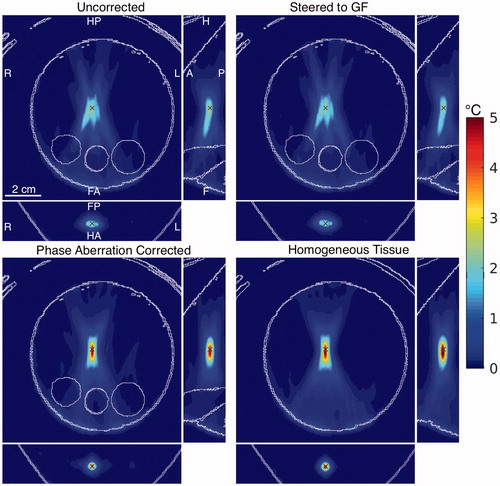 Figure 7. 3 D simulated temperatures corresponding to experimental location 5 (left column of Figure 6). Simulation scenarios include uncorrected (top left) and phase aberration-corrected (bottom left) sonications, as well as simulations in which electronic steering has been used to correct for phase aberration-induced focus shift (top right) and in which homogeneous tissue is assumed (bottom right). Tissue interfaces in the model are identified with white outlines and all images are shown at the end of heating through the geometric focus (× marker).
