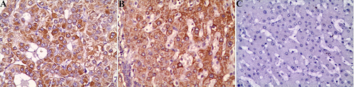 Figure 4 Expression of ERK1/2 mRNA. (A) Positive expression of ERK1/2 mRNA in HCC×200. (B) Positive expression of ERK1/2 mRNA in HBV-LC ×200. (C) Negative expression of ERK1/2 mRNA in normal liver tissue×200.