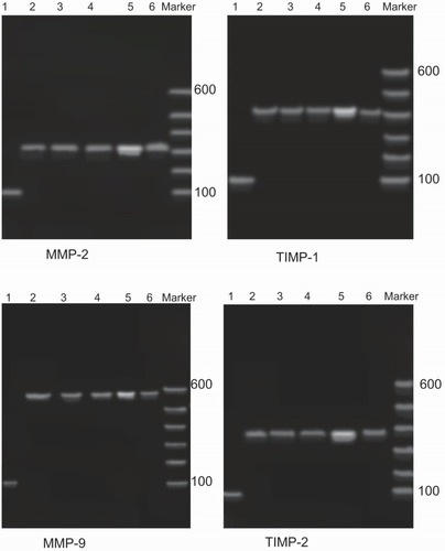 Figure 2 The PCR results for MMPs and TIMPs. Agarose gel electrophoresis showing that the lengths of the mRNA fragments of MMP-2, MMP-9, TIMP-1, and TIMP-2 were 320 bp, 582 bp, 405 bp, and 372 bp, respectively. The PCR bands of MMPs and TIMPs in patients with DTC were the brightest; after surgery, the brightness of these bands was significantly reduced. Moreover, there were no significant differences compared with the control group and the benign thyroid tumor group. 1: β-actin; 2: healthy individual; 3: benign thyroid tumor (prior to surgery); 4: benign thyroid tumor (after surgery); 5: DTC (prior to surgery); 6: DTC (after surgery).