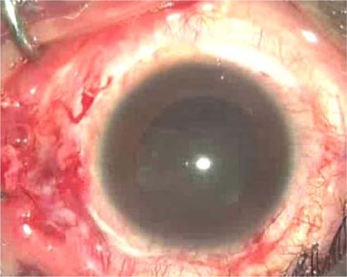 Figure 1 Intraoperative view, showing a nasal entry site.