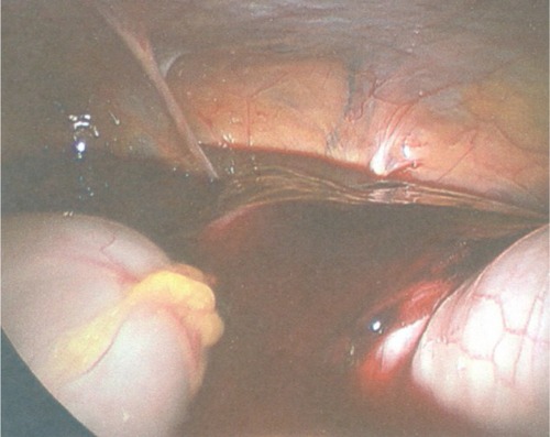 Figure 1 Laparoscopic photograph showing heavy postoperative bleeding.