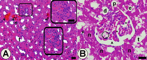 Figure 7. Light microscopy of kidney in the low-dose haloperidol-given group. Arrow heads: cells of tubules that have pyknotic nuclei and eosinophilic cytoplasm. *Hydropic vacuolation in tubule cells. Abbreviations: t = tubular lumen, boxed areas subjected to focal necrosis; d = distal tubule surrounded with vacuolated cells; n = necrotic tubules and necrotic tubule cells; arrow = desquamated cell in the lumen; e = eosinophilic accumulation in proximal tubule lumen and vacuolated tubule cells; ˆ = dilated Bowman space. Circled area = space that occurred after mesangial cells damage; + = dilated glomerular capillaries. Also in B, + indicates thickening in the basal membrane of the intraglomerular capillary. The inset shows boxed areas of A at high magnification. Dye: Hematoxylin-eosin; Magnification bars: 40 μm.