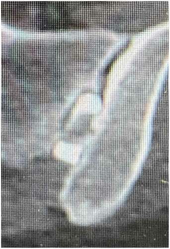 Figure 6. 3 month CT of Linq implant demonstrating early bridging and fusion.