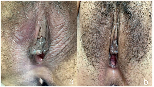 Figure 4. The lesion changed after FU treatment at 4.0 mm focal depth. (a) Clinical appearance before treatment. (b) The skin elasticity and pigmentation of the vulva were almost normal after 3 months of follow-up.