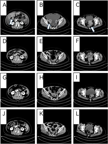 Figure 1 Abdominal CT before and after treatment. (A–C) (November 24th, 2021) A baseline abdominal computed tomography (CT) scan before treatment. (D–F) (January19th, 2022) After “bevacizumab + albumin-bound paclitaxel + Cisplatin” treatment was given for 2 cycles. (G–I) (April21th, 2022) After “bevacizumab + albumin-bound paclitaxel + Cisplatin” treatment was given for 5 cycles. (J–L) (May8th, 2023) After “Oral anlotinib maintenance therapy” was given for 12.5 months.