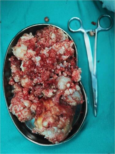 Figure 4 Multiple cartilaginous loose bodies found in the joint cavity excised and sent for biopsy.