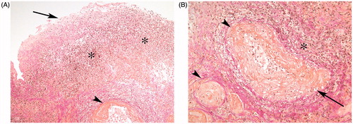 Figure 2. (A) Superficial part of the urinary bladder: ulceration with fibrin and inflammatory cells (arrow), chronic inflammation and granulation tissue (star), and dilated vessels with signs of vasculitis (arrowhead). Magnification 100×. (B) Deeper bladder wall: vessels with fibrinoid degeneration and neutrophils as in vasculitis (arrowhead) and chronic inflammation (star). Magnification 200×.