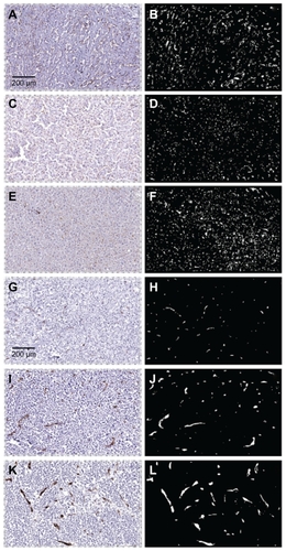 Figure 5 Photomicrographs of vessel staining in three cases of metastatic breast cancer in liver. Images on the left are immunostained histological sections. On the right are the same sections visualized in black and white to highlight the CD31-stained vasculature. Panels A–F are from normal liver and panels G–L are from matched tumors. At low power the normal sections show a fine meshwork of capillaries. In contrast, tumors exhibit vessels that are generally larger in size and fewer in number.