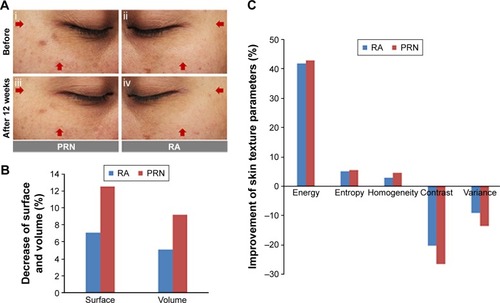 Figure 7 Antiaging efficacy of PRN and RA.Notes: (A) Representative pictures of a preorbital skin area (tested area) of a volunteer at day 0 (before, i and ii) and day 84 (after 12 weeks post-first application, iii, iv) of the treatment (twice-daily application, at ~0.004 mg retinoid/cm2 of the skin, for each application) with PRN (i and iii) and RA (ii and iv). Red arrows indicate areas with significant improvement after a 12-week treatment. (B) Decrease (%) in the surface and volume parameters of volunteers’ skin after the twice-daily applications of PRN and RA for 12 weeks. (C) Change (%) in the skin texture parameters (energy, entropy, homogeneity, contrast, and variance) of volunteers after the twice-daily applications of PRN and RA for 12 weeks.Abbreviations: RA, retinoic acid; PRN, proretinal nanoparticles.