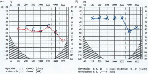 Figure 3. Audiogram of the patient before the dexamethasone treatment: moderate hearing loss on all frequencies on the affected side (A: right side). Normal hearing on the unaffected side in EH (B: left side). O: air conduction, [: bone conduction (right), x: air conduction, >: bone conduction (left).
