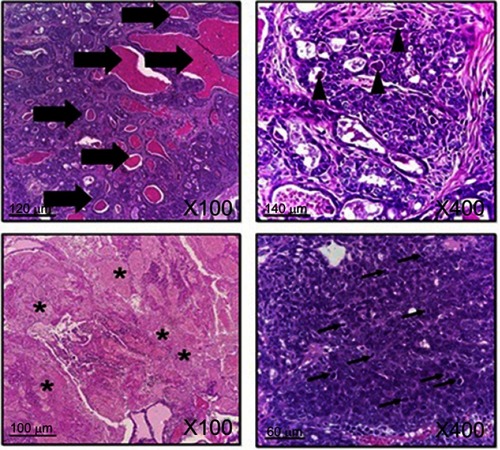 Figure 11 Histopathology of treated breast cancer. Thick arrows: glandular formation; arrowheads: bizarre cell formation; asterisks: massive necrosis; thin arrows: mitotic figures. H&E stain.