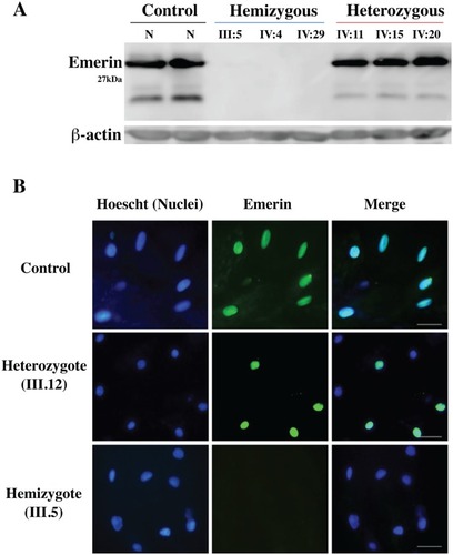 Figure 4 Immunoblot and immunohistochemistry results revealed that EMD hemizygous individuals do not express emerin protein. (A) Immunoblotting of emerin protein (29 kDa) expression from total protein extracts of lymphocytes from the hemizygotes (III5, IV4, IV29), heterozygotes (IV11, IV15, IV20) and a normal control, with use of the emerin monoclonal antibody. No emerin protein bands were detected in the hemizygous patients. (B) Left panels, nucleus (Hoechst) staining (blue); middle panels, emerin staining (green); right panels, merged emerin and nucleus staining. Patients include a normal male control, heterozygote female (III.12) and a male hemizygote (III.5). Scale bar represents 50 μm.