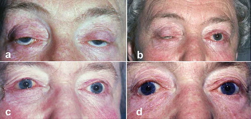 Figure 3. Female of 54, with severe acquired myogenic ptosis and spastic entropion RLL – satisfactory result after 20 mm MT flap resection. (a) Pre-op; (b) left eye at one week post-op, note worsening of RUL ptosis, as predicted by Herring’s law; (c) right eye, one week post-op, MT flap resection, and entropion correction. (d) Final satisfactory result at 3 months.Reproduced from Br J Ophthalmol. Mehta HK, The contralateral upper eyelid in ptosis: some observations pertinent to ptosis corrective surgery, 63(2):120–124. Copyright 1979, with permission from the BMJ Publishing Group.
