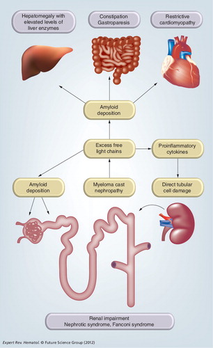 Figure 2. A simplified diagram illustrating clinical manifestations and complications of multiple myeloma related to excess production of free light chains.Excess production of free light chains is responsible for tubular cast formation and obstruction (myeloma cast nephropathy), induction of proinflammatory cytokines and consequent direct tubular cell injury, functional impairment (Fanconi syndrome) and a state of chronic inflammation through interference with neutrophil apoptosis. In addition, deposition of fragments of free light chains causes amyloidosis in several organs, including the liver, small intestine and heart, with subsequent end-organ injury, resulting in hepatomegaly, constipation and cardiomyopathy, respectively Citation[2,11,20–23,25,26].
