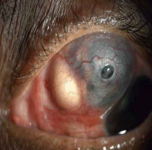 FIGURE 2  Slit-lamp photograph showing pus points and perforation of nodular scleritis.