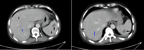 Figure 2 Abdominal CT reveals multiple low-density lesions in the liver and spleen (black arrows), along with multiple small calcifications (blue arrows).