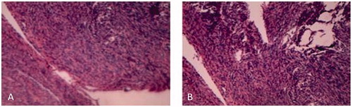 Figure 3. Microscopic examination revealed smooth muscle proliferation (hematoxylin and eosin 10 × 10).