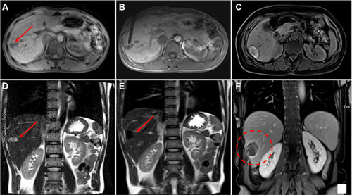 Figure 1 A 62-year-old patient with metastasis (28 mm) of colonic carcinoma. (A and D) Preinterventional planning imaging and MR‐guided targeting (Red arrow). (B) The image shows the precise positioning of the antenna into and ablation of the lesion on the transverse position. (C and E) High-signal target tumor lesions are clearly visible in the unenhanced T2 sequence. (F; dashed circle) After one day of precise ablation, enhanced magnetic resonance reexamination found the signal of the target lesion changed significantly, forming a round-shaped low-signal target sign.