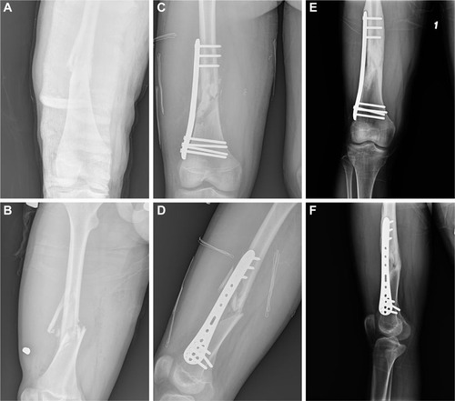 Figure 1 A 17-year-old male patient with Type 2 open femur fracture due to traffic accident.