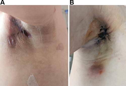 Figure 2 Skin ulceration and yellow pus after the second operation. (A) On the left breast fold, there was swelling, ulceration, and purulent secretions. (A–B) The bilateral axillary region showed poor healing after a second debridement and negative pressure drainage for VSD.