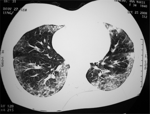 Figure 1 CT pulmonary angiography showing basal and peripheral interstitial shadowing bilaterally.