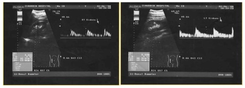 Figure 5 (A) Patient presents with acute left sided renal colic. Spectral waveform from the arcuate arteries of the both kidneys shows normal RI of 0.60 and 0.68. However delta RI is elevated.