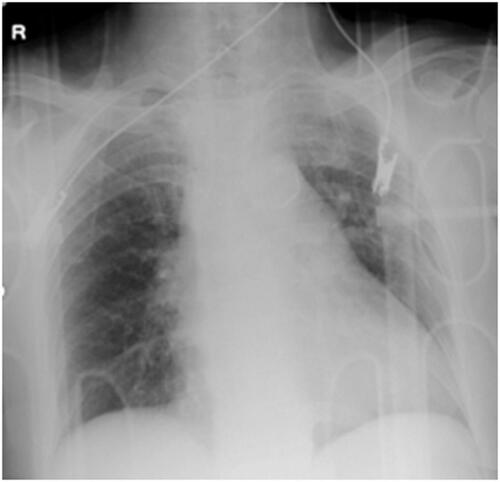 Figure 1 A chest X-ray on arrival. No obvious rib fractures were seen.