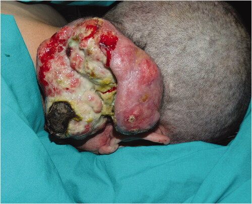 Figure 6. Infected and ulcerated tumor located in the right occipital region.