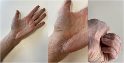 Figure 5. Status 6 months post-op with silicone treatment of scar-tissue. (right) Slight limitation of end range of motion of flexion of the fourth digit.