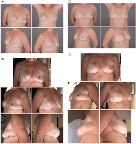 Figure 1. Examples of postoperative photographs evaluated in the study. (A) An expander prosthesis (EP) breast reconstruction in two-dimensional (2 D) format and in (B) three-dimensional (3 D) format. (C) A deep inferior epigastric perforator (DIEP) flap breast reconstruction in 2 D format and in (D) 3 D format.