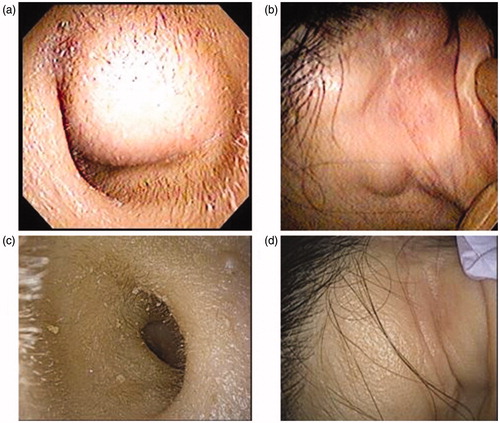 Figure 1. Tumors of the external auditory canal and auricle. (a, b)At the initial visit, a painless mass with a smooth surface was found in the right external auditory canal which was almost completely occluded. Also, several tender masses with severe pain were observed around the right auricle. (a) Inside the right ear. (b) Behind the right ear. (c, d) Three years after surgery, no recurrence is observed either in the ear or the subcutaneous region behind the ear. (c) Inside the right ear (after surgery). (d) Behind the right ear (after surgery).