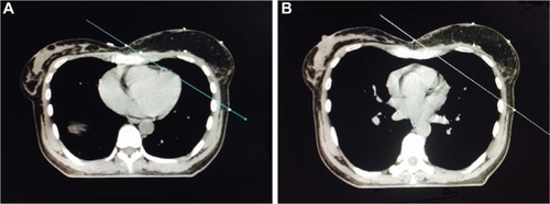 Figure 1 Central axis slice of CT planning scans acquired in free-breathing (A) and deep-inspiration breath-hold (B) in a representative patient showing heart position in relation to the back edge of the field placements. The diagonal line represents the back edge of the treatment area.