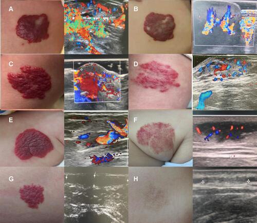 Figure 1 Images of before and after treatment and evaluation of efficacy.(A and B) Grade I (invalid) regression was defined by tumor reduction of <25%, no obvious change in color, no reduction in the tumor echo signal, and high blood flow on color Doppler ultrasound examination; (C and D) Grade II (effective) regression was defined by tumor reduction of 25%–50%, color gradually becomes lighter, resolution of maximum abnormal blood flow on color Doppler ultrasound examination; (E and F) Grade III (marked effect) regression was defined by tumor reduction of >51%, the color is visibly lighter, and marked resolution of abnormal blood flow signals on color Doppler ultrasound examination; and (G and H) Grade IV (healed) regression was defined by tumor reduction of >75%, the color basically disappears, and complete resolution of the abnormal blood flow signals on color Doppler ultrasound examination.