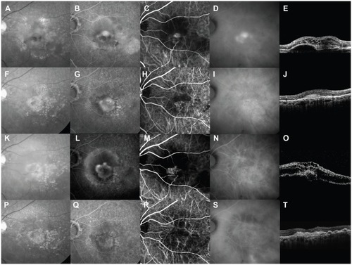 Figure 1 A 64-year-old woman was treated with intravitreal bevacizumab for stage 3 retinal angiomatous proliferation (RAP). At baseline, best-corrected visual acuity (BCVA) was 0.1 decimal visual acuity in the left eye. (A) Red-free photograph showing intraretinal and preretinal hemorrhages, drusen, retinal pigment epithelial detachment, and lipid. (B) Fluorescein angiography showing minimal classic choroidal neovascularization and intraretinal edema. (C) Early-phase indocyanine green angiography showing RAP lesions within the retina and beyond as well as retinal-choroidal anastomosis (RCA). (D) Late-phase indocyanine green angiography showing RAP lesions as focal areas of intense hyperfluorescence (hot spots) and staining of fibrin in cystoid spaces. (E) Baseline horizontal optical coherence tomography (OCT) image shows cystoid macular edema and a pigment epithelial detachment. (F) At month 3, after three consecutive monthly intravitreal bevacizumab injections, no hemorrhages, pigment epithelial detachment, or decreased lipid content are visible on a red-free photograph. BCVA improved from 0.1 to 0.2 decimal visual acuity. (G) No leakage or pigment epithelial detachment are seen on fluorescein angiography. (H and I) Indocyanine green angiography shows decreased leakage from RAP lesions, but RCA and neovascular complex remain. (J) OCT showing disappearance of edema and pigment epithelial detachment. No additional treatment was performed. (K) Red-free photograph at month 6 shows recurrence of intraretinal and preretinal hemorrhages, edema, and pigment epithelial detachment. BCVA decreased from 0.2 to 0.1 decimal visual acuity at month 3. (L) Fluorescein angiography shows enlargement of leakage and pigment epithelial detachment. (M) Early-phase indocyanine green angiography shows enlargement of the neovascular complex and thickening of the RCA. (N) No hot spot was seen on late-phase indocyanine green angiography. (O) OCT shows severe edema and expansion of pigment epithelial detachment. We retreated with intravitreal bevacizumab plus photodynamic therapy instead of intravitreal bevacizumab. (P) Three months after intravitreal bevacizumab plus photodynamic therapy (month 9), a red-free photograph shows disappearance of intraretinal and preretinal hemorrhages, edema, and pigment epithelial detachment. (Q and S) Fluorescein and late-phase indocyanine green angiography showing no leakage. (R) Early-phase indocyanine green angiography showing complete disappearance of RCA. (T) Horizontal OCT image shows flattening of the neurosensory retina. BCVA was 0.2 decimal visual acuity.