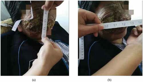 Figure 5. At the end of radiotherapy, the tumor was remarkably decreased in size.