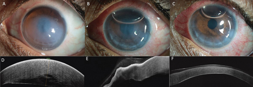 Figure 5. (a-f)- a: Slit-lamp photograph of the right eye when patient presented with a 10 days history of spontaneous hydrops shows an area of differential transparency in the mid periphery; b: Slit-lamp photograph of the right eye 1 h after the surgery shows remarkable reduction of corneal edema; c: Slit-lamp photograph on the first postoperative day shows clear visual axis; d-f: The corresponding optical coherence tomography pictures at pre-op, 1 h and 1 day are shown in d, e, and f, respectively.