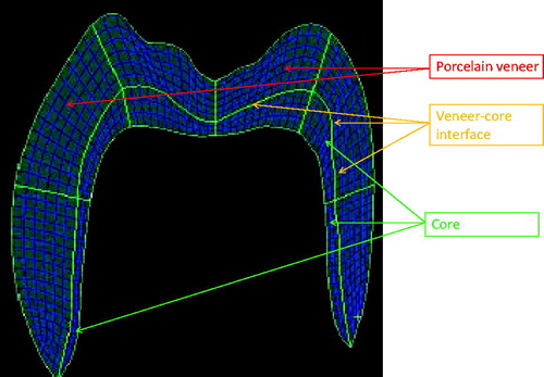 Figure 1. Finite elements model (FEM) of a crown composed by layers of quadrilateral elements simulating the core structure (green arrows) and layers of quadrilateral elements simulating the veneer structure (red arrows), green arrows indicate the veneer–core interface.