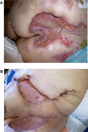 Figure 3 After treatment with immunosuppressive medications, appearance of sacral (A) and abdominal and left thigh (B) pyoderma gangrenosum.